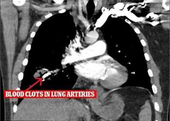 Healthy cocaine users could still be at serious risk after man, 34, suffered deadly blood clots from occasional drug use