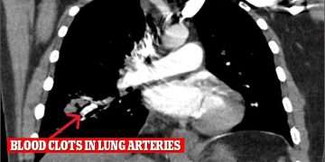 Healthy cocaine users could still be at serious risk after man, 34, suffered deadly blood clots from occasional drug use