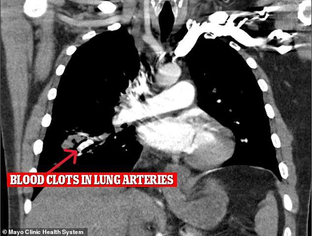 Healthy cocaine users could still be at serious risk after man, 34, suffered deadly blood clots from occasional drug use