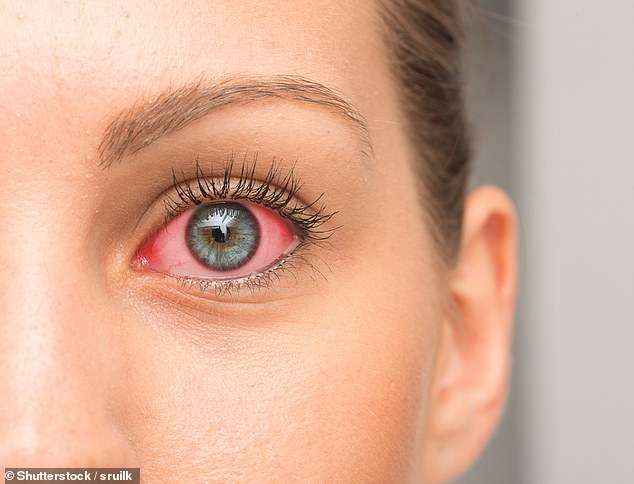 Public health officials in Michigan investigate five cases of EYE SYPHILIS in women who had sex with super-spreader man