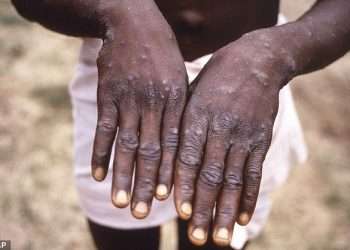 World Health Organization declares ultra-deadly monkeypox strain a public health emergency of international concern