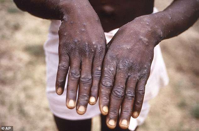 World Health Organization declares ultra-deadly monkeypox strain a public health emergency of international concern