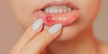 DR ELLIE: My mother is plagued by mouth ulcers – can we find her a remedy?