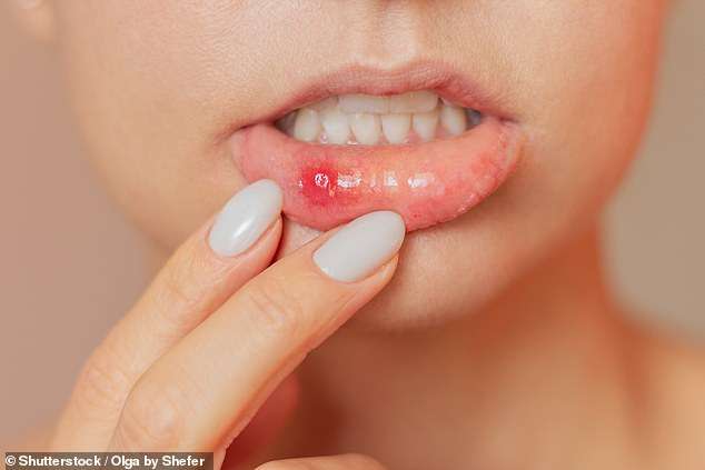 DR ELLIE: My mother is plagued by mouth ulcers – can we find her a remedy?