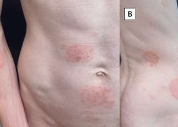 Rise of the super skin fungus: It causes a painful rash, is drug-resistant and you can get it at the hairdresser. Yet doctors keep missing these vital symptoms