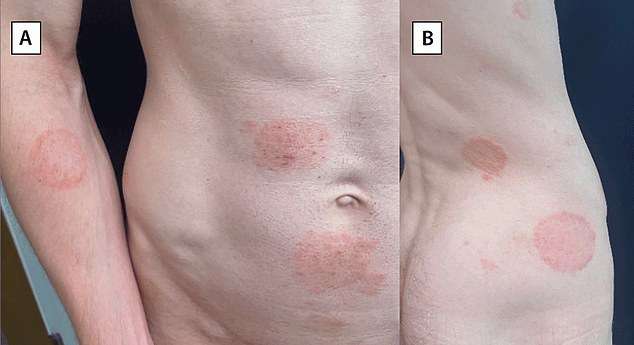 Rise of the super skin fungus: It causes a painful rash, is drug-resistant and you can get it at the hairdresser. Yet doctors keep missing these vital symptoms