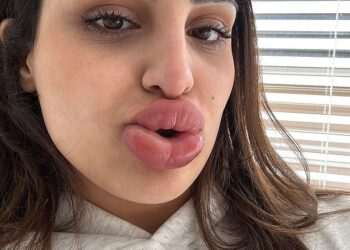Horrific reaction to popular cosmetic tweak leaves woman, 24, looking like a Bratz doll