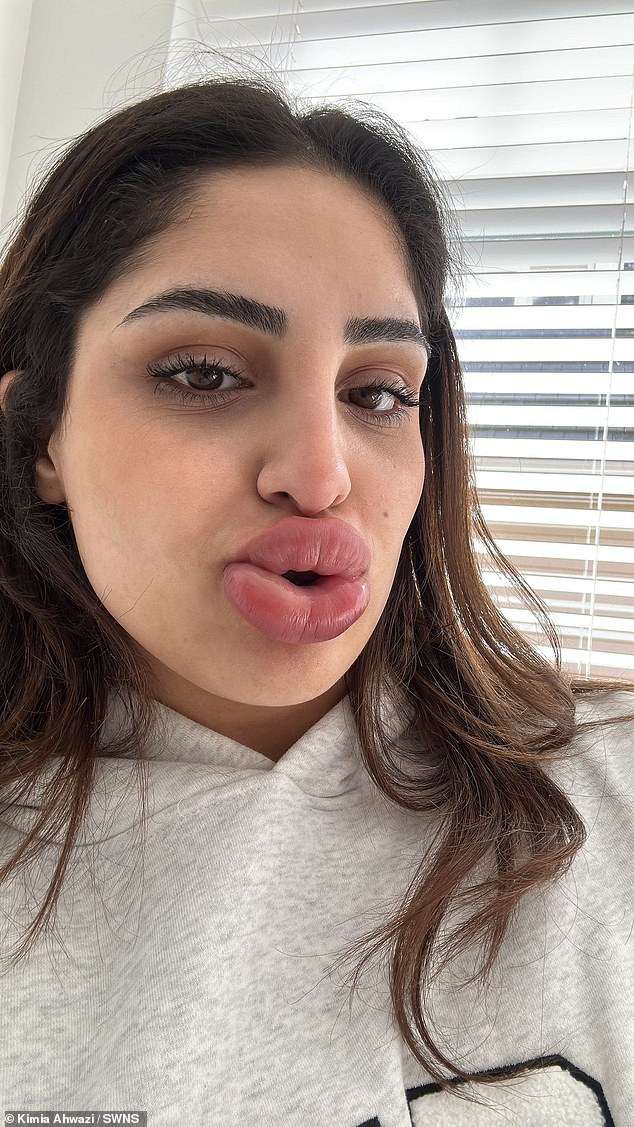 Horrific reaction to popular cosmetic tweak leaves woman, 24, looking like a Bratz doll