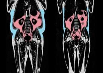 ‘Hidden’ fat is silently ageing you – one common body shape is most at risk, scientists warn