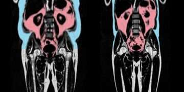 ‘Hidden’ fat is silently ageing you – one common body shape is most at risk, scientists warn