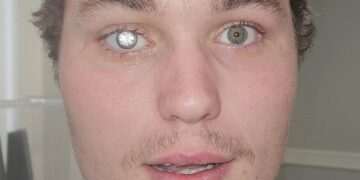 A real-life Bond villain! Jewellery store owner has a 2-carat DIAMOND embedded into his artificial eye