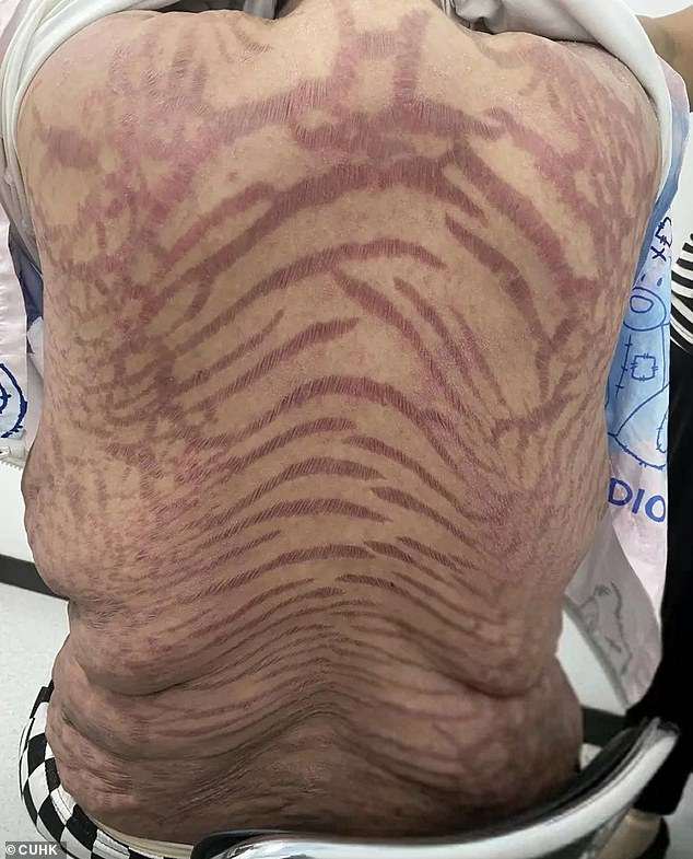 Woman’s skin develops purple snake-like pattern after applying ‘mystery’ cream she bought online