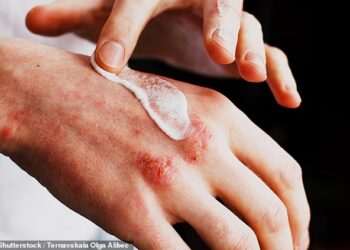 Eczema cream sold on Amazon urgently recalled because it is tainted with deadly bacteria