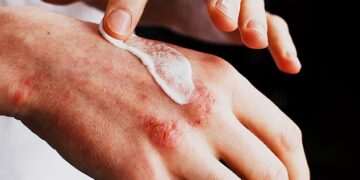 Eczema cream sold on Amazon urgently recalled because it is tainted with deadly bacteria