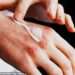 Eczema cream sold on Amazon urgently recalled because it is tainted with deadly bacteria